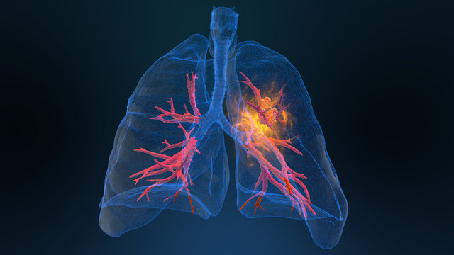 The New FDA-Approved Lung Cancer Drug 